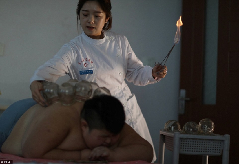 11-year-old Chinese man weighing 150 pounds trying to lose weight with the help of fire