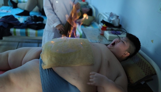 11-year-old Chinese man weighing 150 pounds trying to lose weight with the help of fire