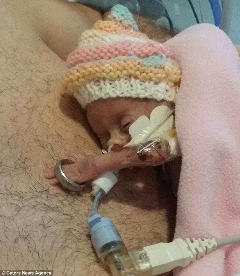 An amazing story of a tiny baby who survived in spite of everything