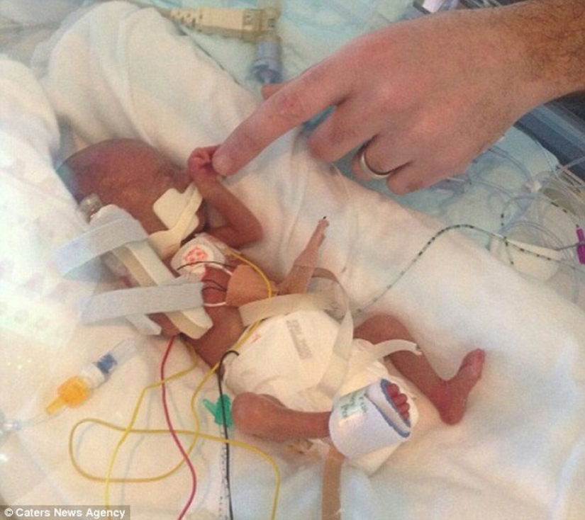 An amazing story of a tiny baby who survived in spite of everything