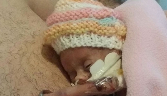 An amazing story of a tiny baby who survived in spite of everything