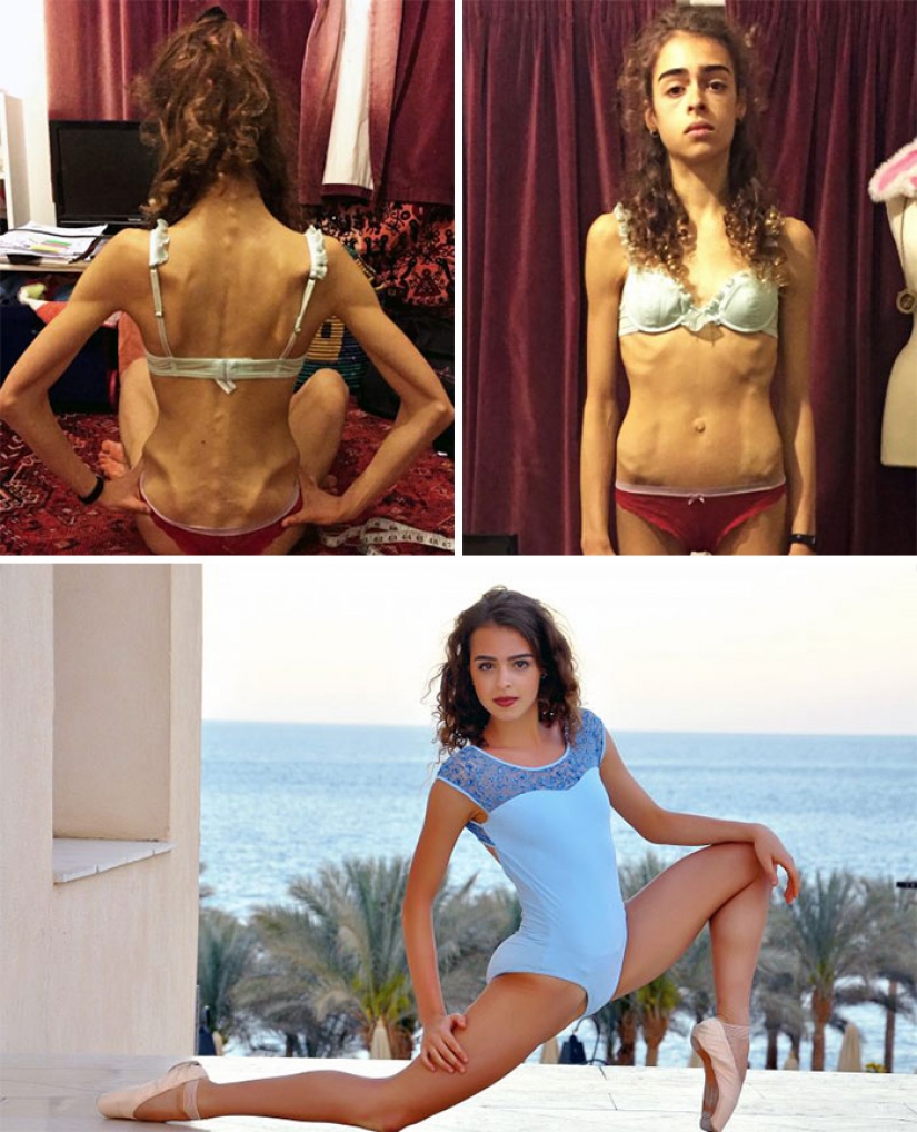 Before and after: 20 examples of people who managed to overcome anorexia