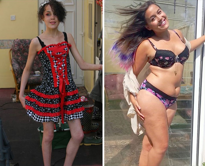 Before and after: 20 examples of people who managed to overcome anorexia