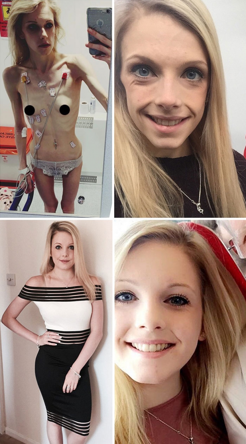 Before and after: 20 examples of people who managed to overcome anorexia