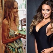 Before and after: 20 examples of people who managed to overcome anorexia