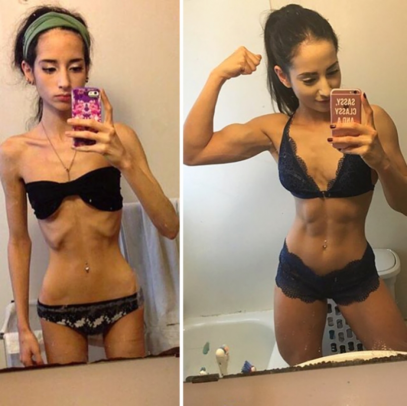 Before and after: 20 examples of people who managed to overcome anorexia