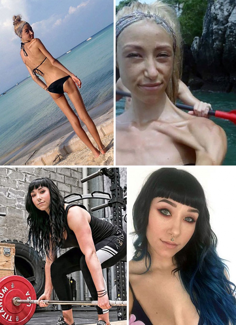 Before and after: 20 examples of people who managed to overcome anorexia