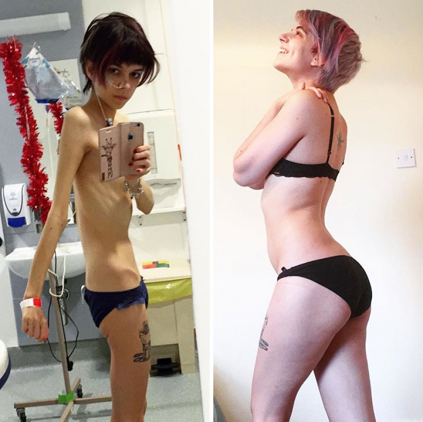 Before and after: 20 examples of people who managed to overcome anorexia