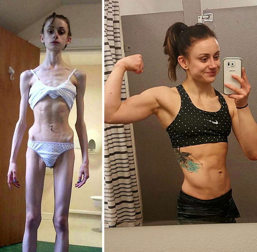 Before and after: 20 examples of people who managed to overcome anorexia