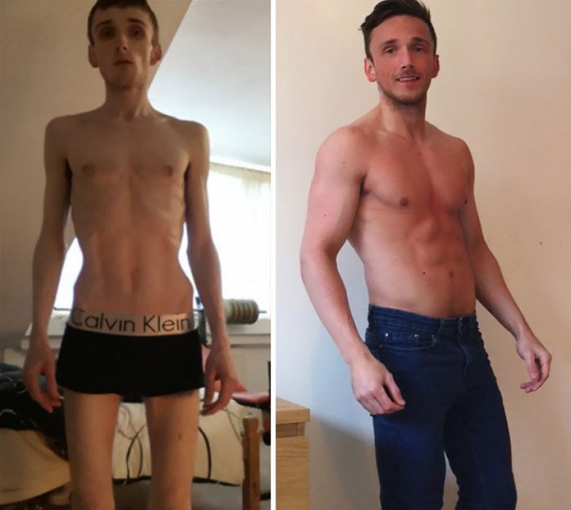 Before and after: 20 examples of people who managed to overcome anorexia