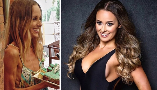 Before and after: 20 examples of people who managed to overcome anorexia Before and after: 20 examples of people who managed to overcome anorexia