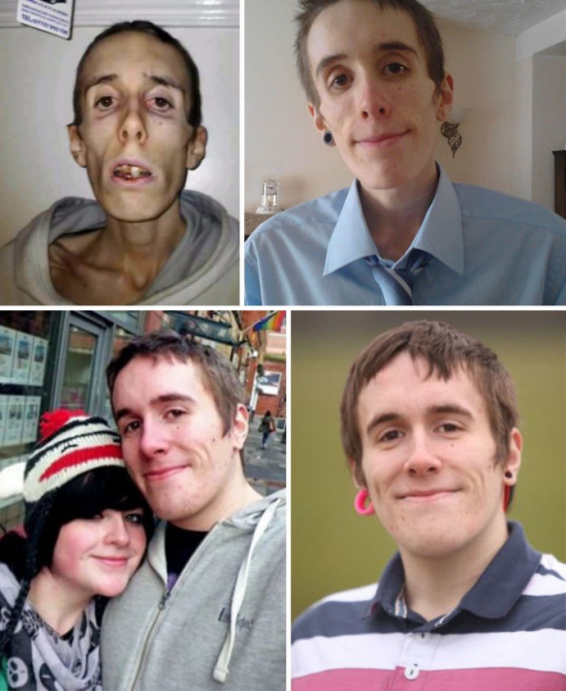 Before and after: 20 examples of people who managed to overcome anorexia