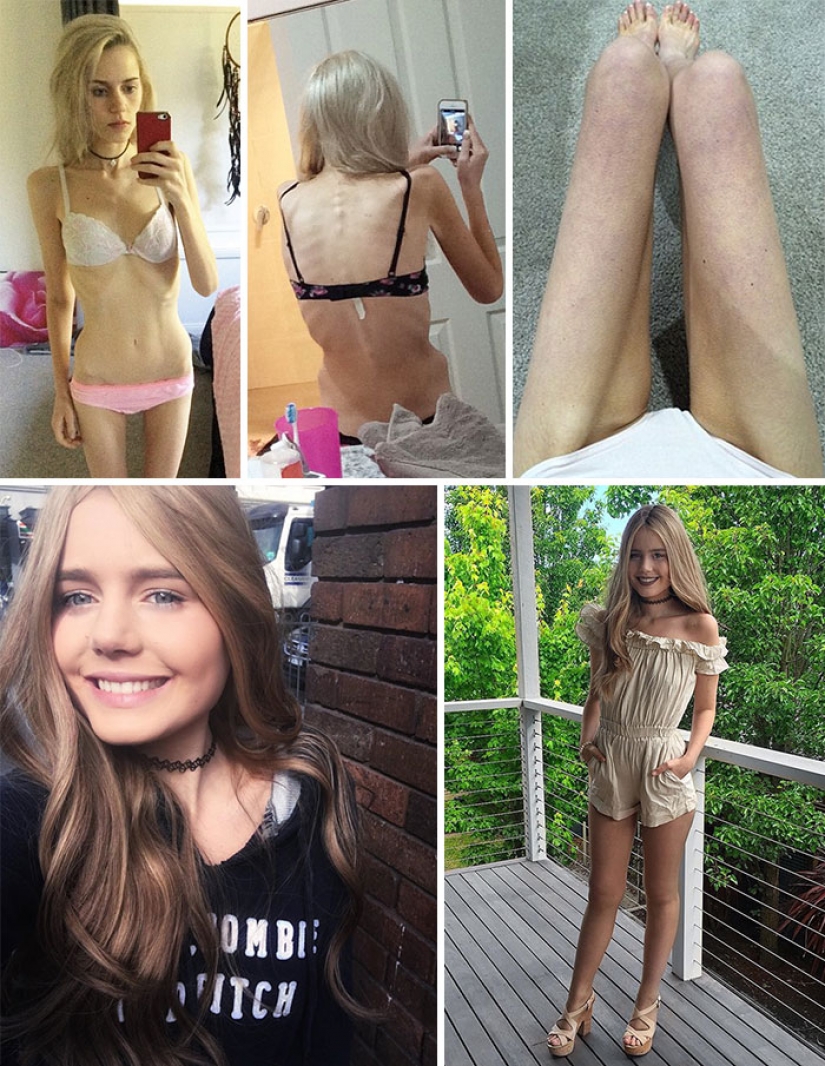 Before and after: 20 examples of people who managed to overcome anorexia