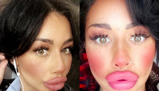 British dumplings: a single mother from Liverpool has spent nearly 2 thousand pounds for a swap of the lips and cannot stop