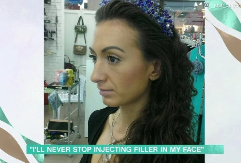 Cheeks-barrels: from Kiev itself injects fillers to be special