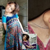 El mundo está en un ángulo recto: cuello de 11 años Pakistaní girado 90 grados