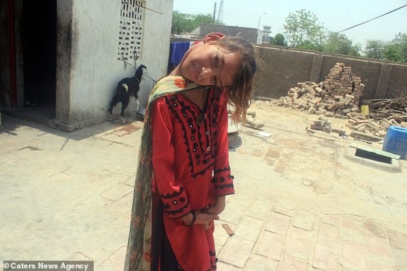 El mundo está en un ángulo recto: cuello de 11 años Pakistaní girado 90 grados