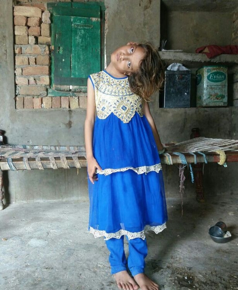 El mundo está en un ángulo recto: cuello de 11 años Pakistaní girado 90 grados