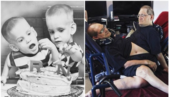 En los Estados unidos, murió el más antiguo de los gemelos siameses Ronnie y Donnie Gelion