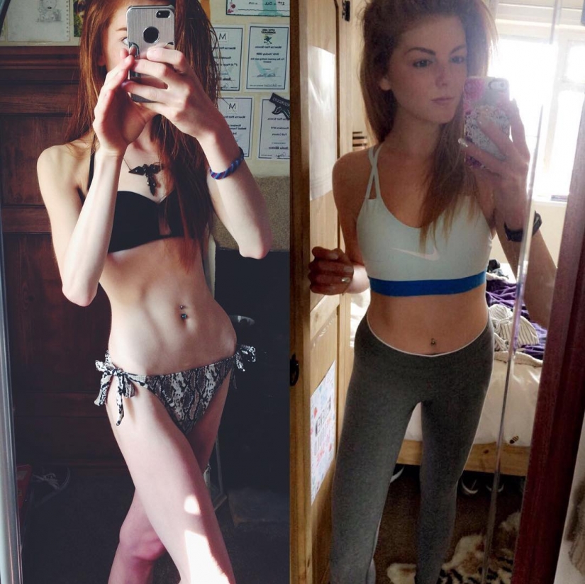 Girl with a weight of 29 kg defeated anorexia with chocolate
