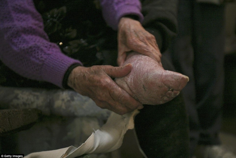 In the village of "bound feet" the last living Chinese women suffering from the ancient brutal tradition