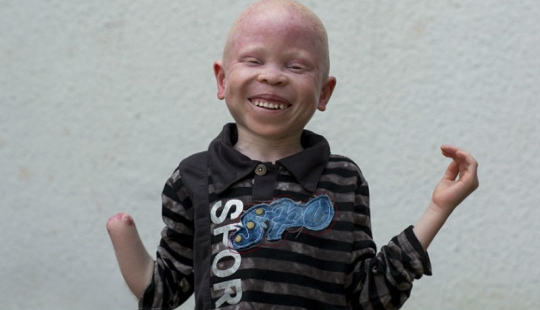 Los albinos de tanzania, cuyos cuerpos valen más que el oro