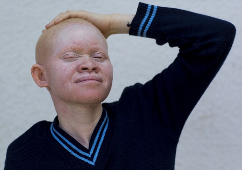 Los albinos de tanzania, cuyos cuerpos valen más que el oro