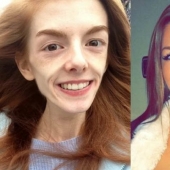 Niña con un peso de 29 kg derrotó a la anorexia con chocolate