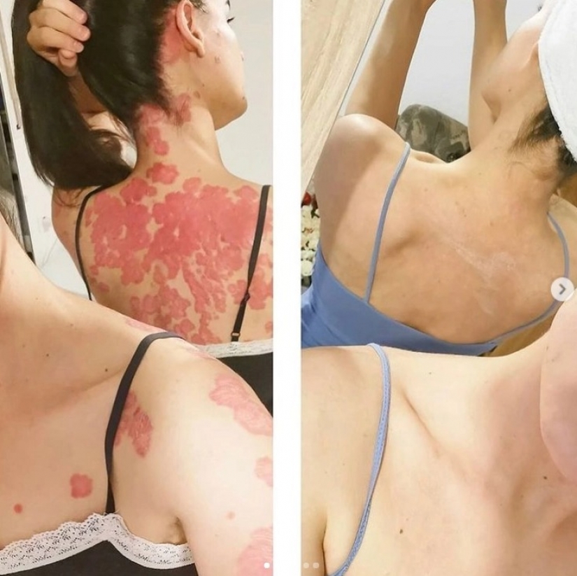 She was cured from psoriasis, thanks to the miracle diet, and now her method helps thousands