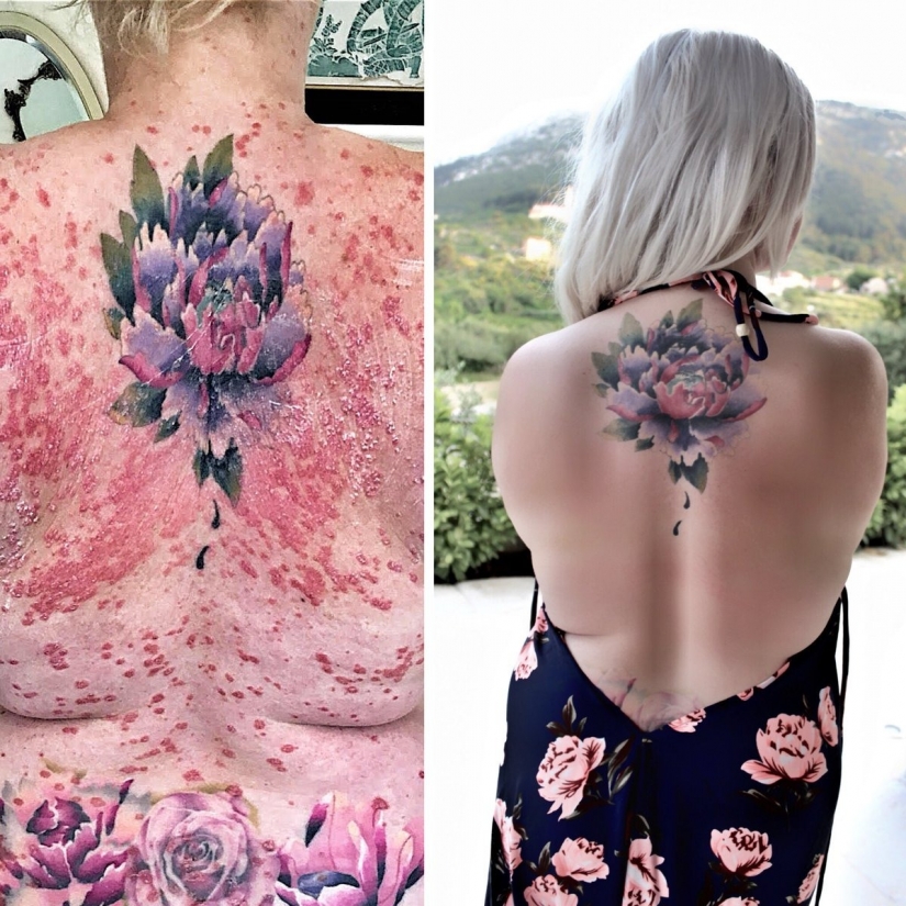 She was cured from psoriasis, thanks to the miracle diet, and now her method helps thousands