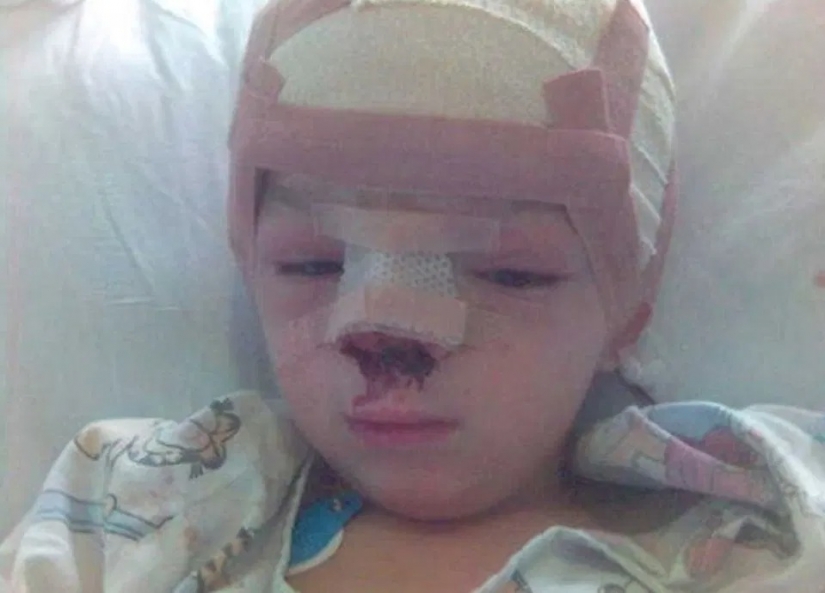 Soldados británicos recaudado dinero para una operación por un muchacho de Bosnia, que nació con un raro defecto en la cara
