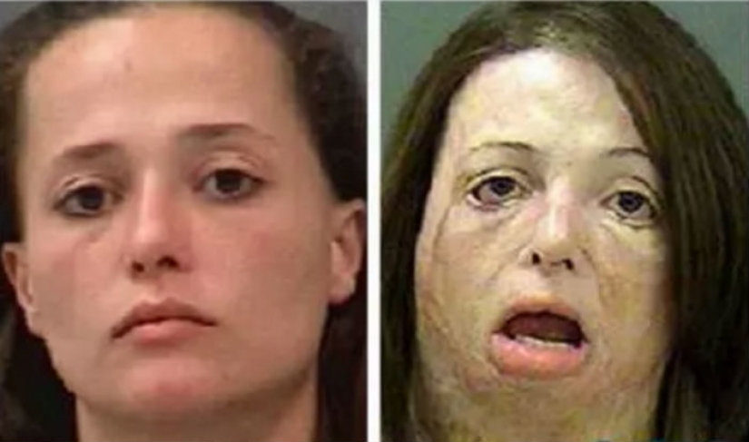 Terrible consequences of the use of methamphetamines