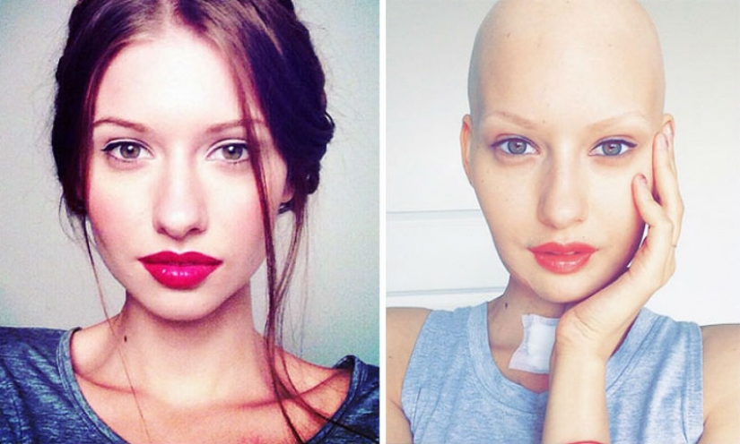 The doctors told the model to have an abortion after she has deleted 95% of the jaw to cancer — and that's what she did