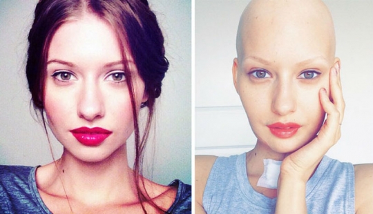 The doctors told the model to have an abortion after she has deleted 95% of the jaw to cancer — and that's what she did