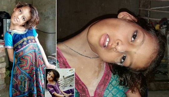 The world is at a right angle: neck 11-year-old Pakistani turned 90 degrees