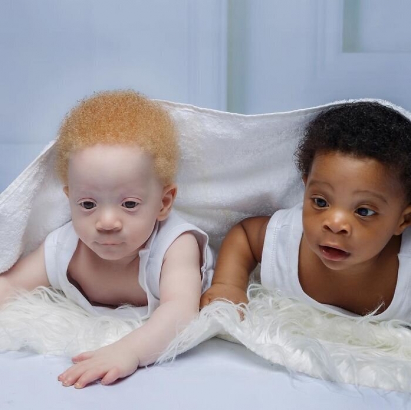 What is the secret of twins with different skin colors from Nigeria