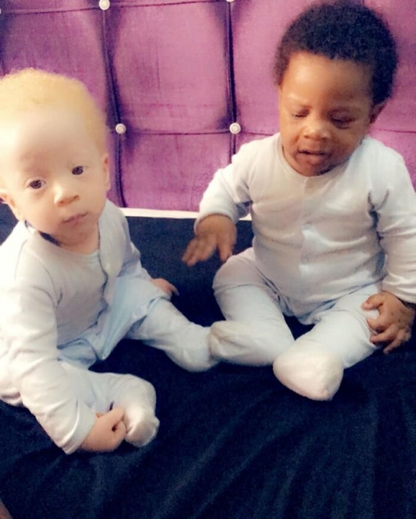 What is the secret of twins with different skin colors from Nigeria