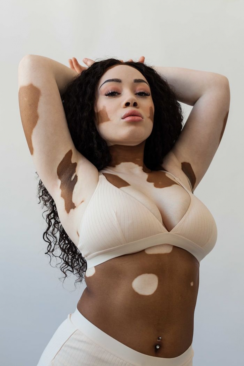 10 beautiful women with vitiligo, photographed by a photographer with the same condition