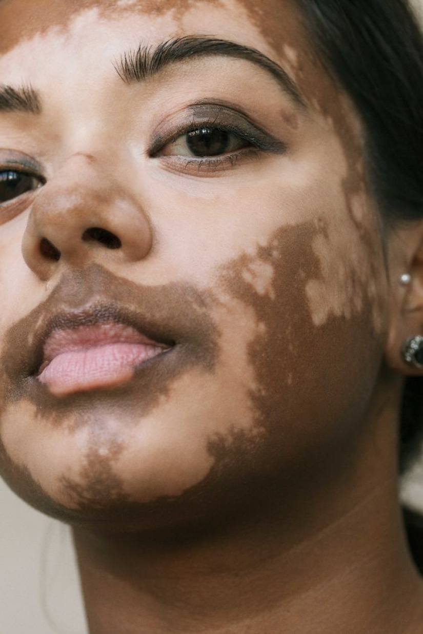 10 hermosas mujeres con vitiligo, fotografiadas por un fotógrafo con la misma condición