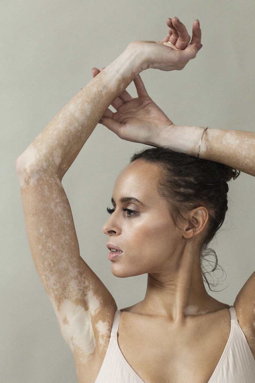 10 hermosas mujeres con vitiligo, fotografiadas por un fotógrafo con la misma condición