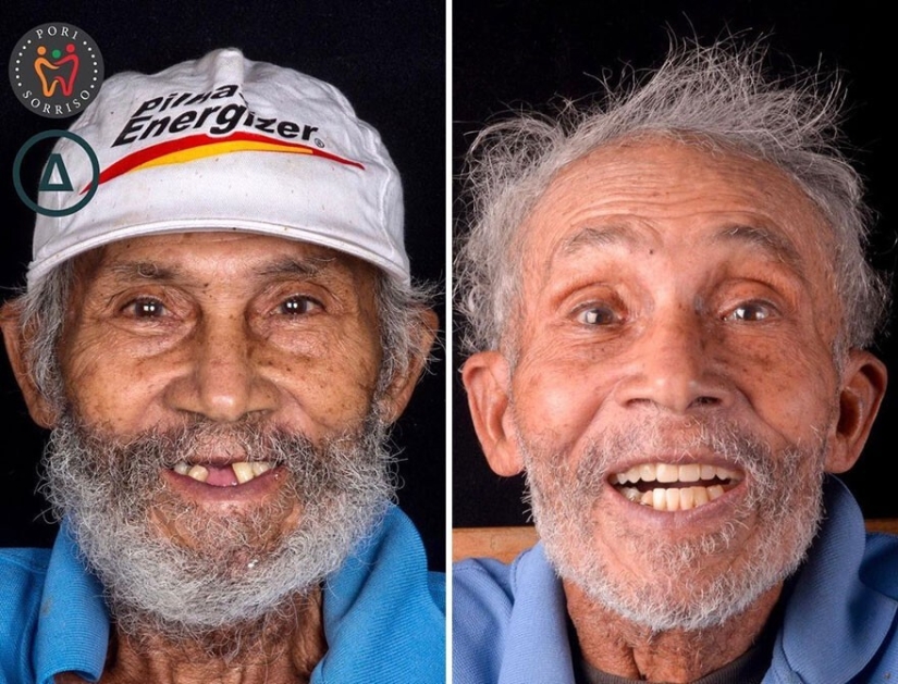30 photos before and after people got their smile back