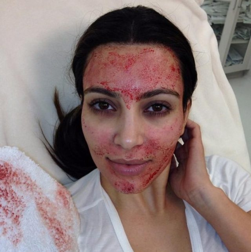 7 horrible cosmetic procedures popular in Hollywood