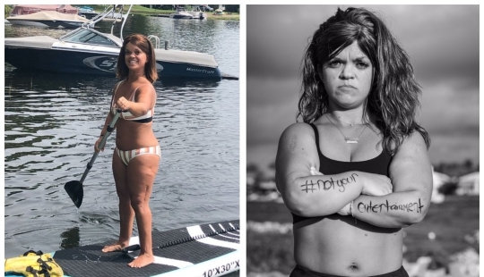 A través del dolor - a un sueño: un enano americano se sometió a operaciones complejas durante muchos años para crecer A través del dolor - a un sueño: un enano americano se sometió a operaciones complejas durante muchos años para crecer