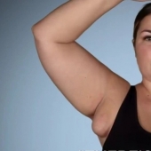 After giving birth, the American woman grew "breasts" under her arms, from which milk oozed