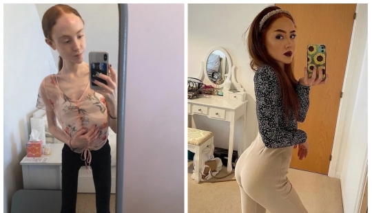Al borde del abismo: cómo una joven escocesa de 25 kg pudo superar la anorexia