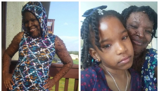 An American woman whose body is covered with two hundred tumors has gained self-confidence thanks to her daughter An American woman whose body is covered with two hundred tumors has gained self-confidence thanks to her daughter