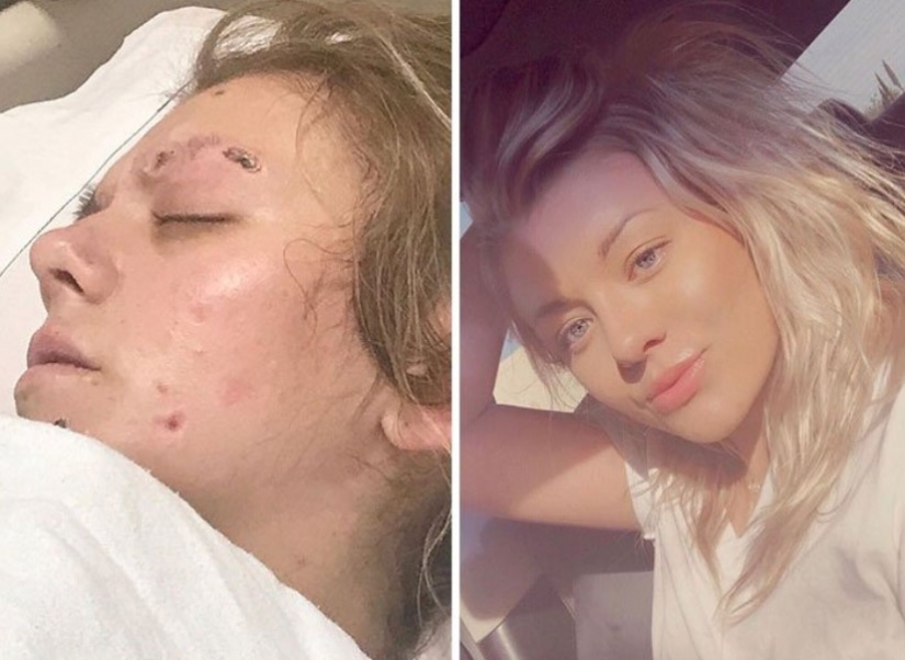 Before and after: 20 photos of people who decided to stop using drugs