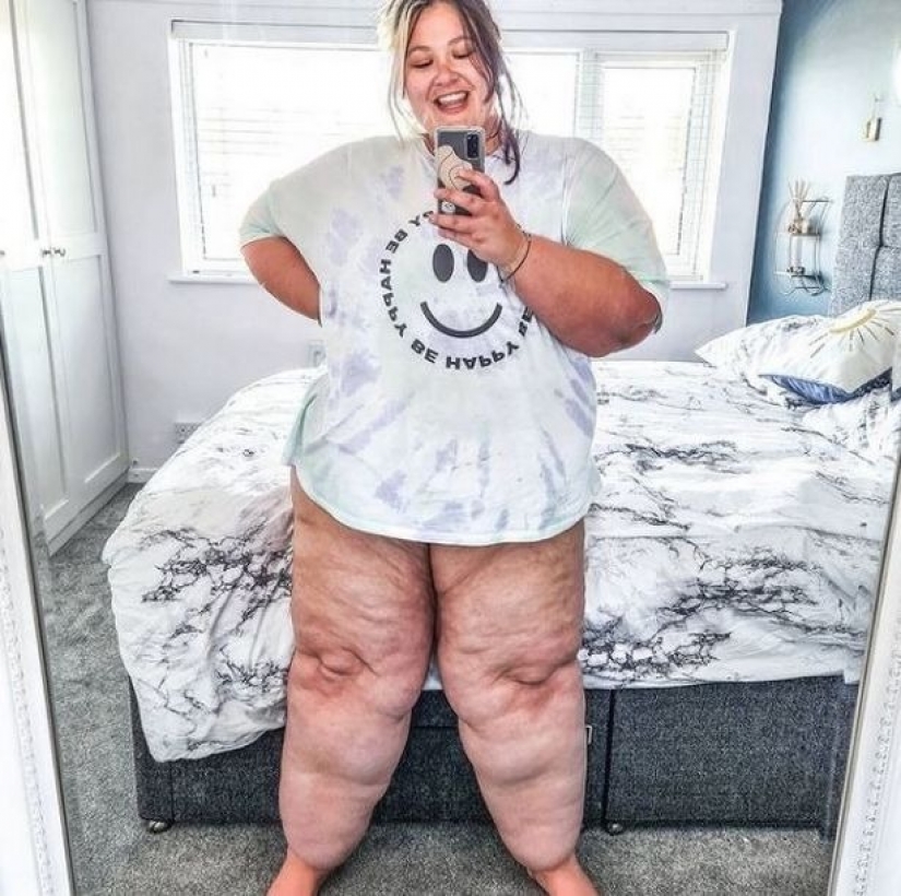 British woman exhausted herself with diets to make her legs lose weight, but it was a disease