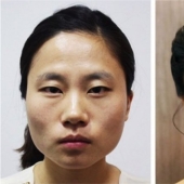 "Cherry lips", jaw reduction, plastic nostrils: what operations are popular in South Korea