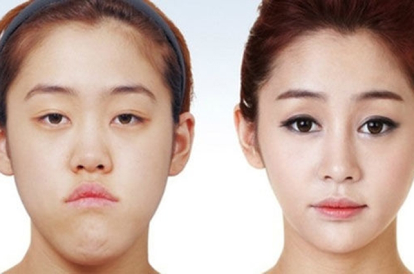 "Cherry lips", jaw reduction, plastic nostrils: what operations are popular in South Korea